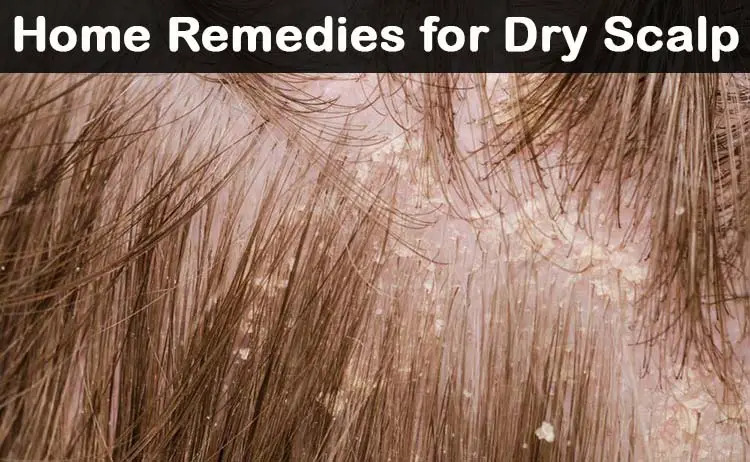 Do You Get Rid Of Dry Scalp