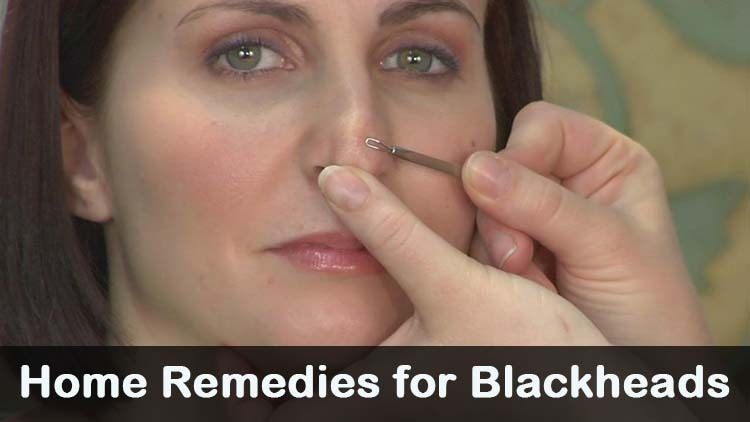 What are some methods for extracting blackheads from skin?