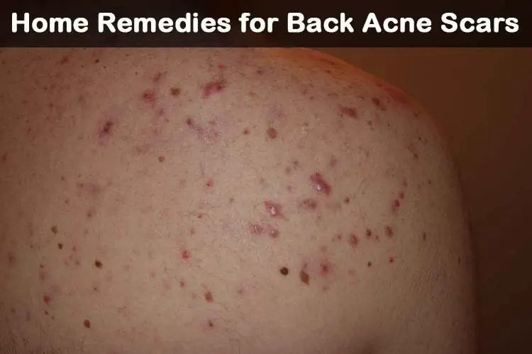 21 DIY Home Remedies for Back Acne Scars - HealthRemediesforLife.com