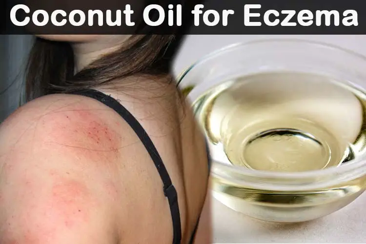 How To Use Coconut Oil For Eczema