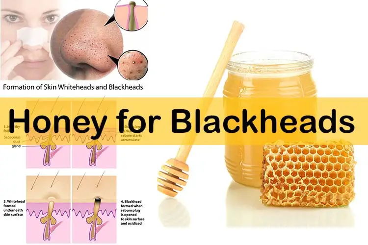 Home Remidies To Get Rid Of Blackheads And Dark Spots 2015 Personal 