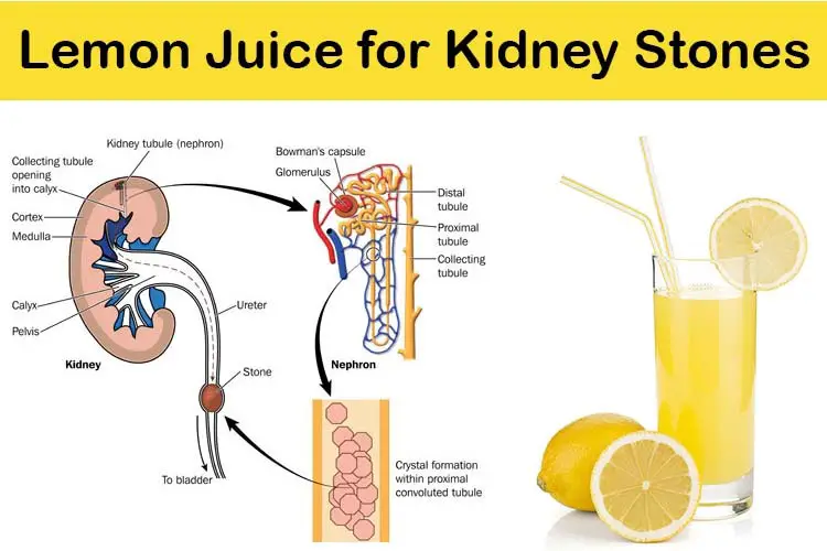 What foods should you avoid to prevent kidney stones?