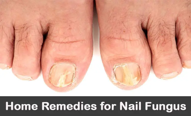 How do you cure foot fungus with vinegar?
