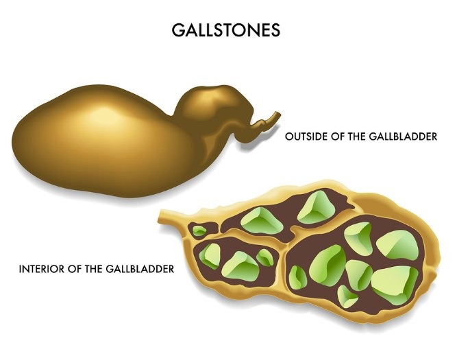 How do you get rid of gall stones?
