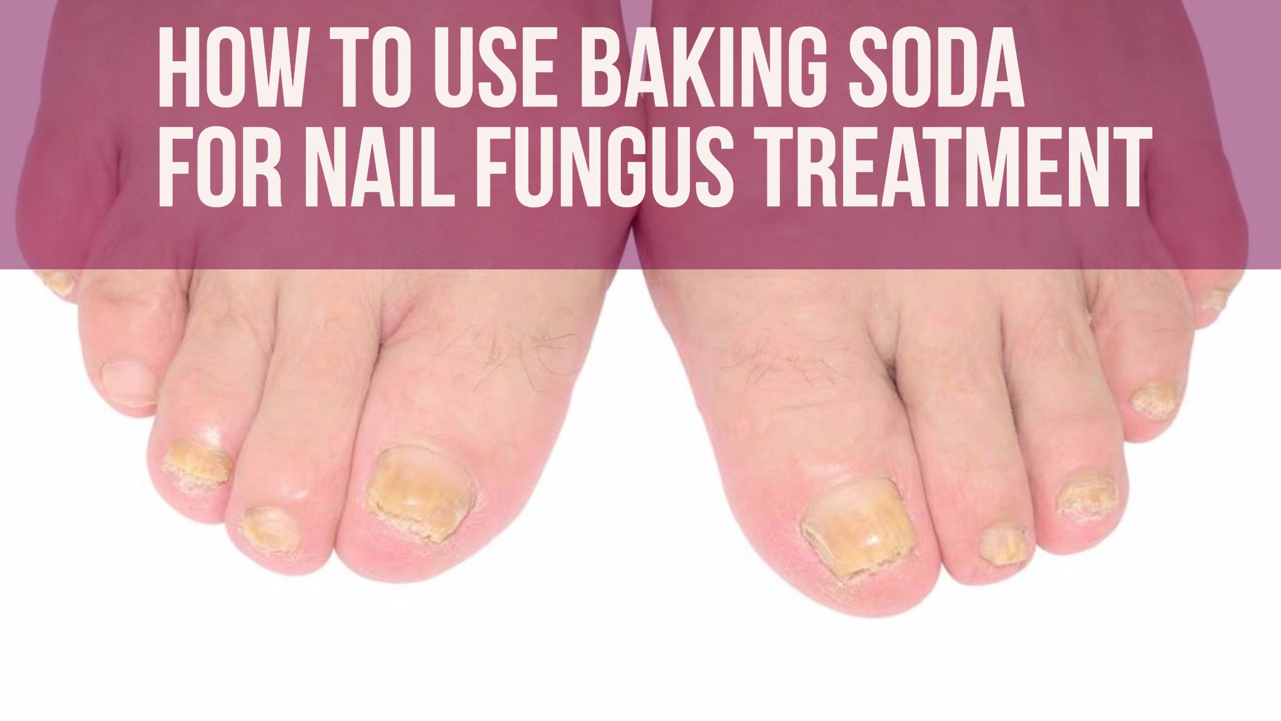 Is vinegar a cure for foot fungus?